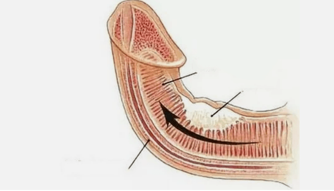 Elimination of venous flow